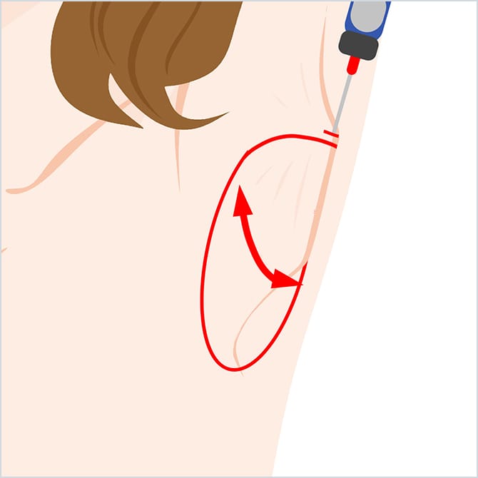 シェーバーを挿入し、汗腺を除去するイメージ
