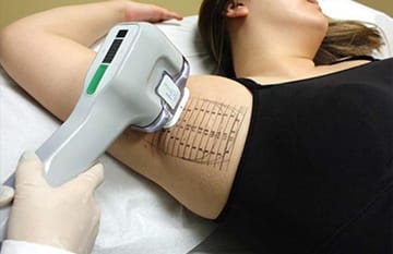 ミラドライを照射