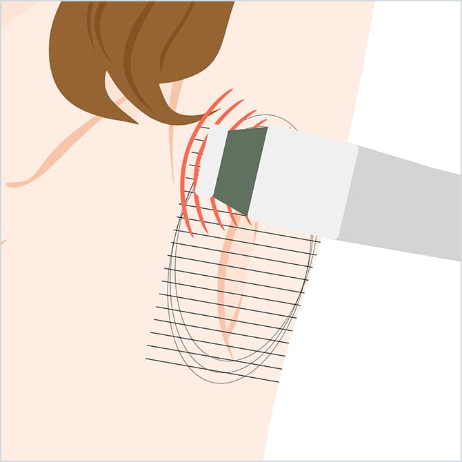 ミラドライによるマイクロ波の照射