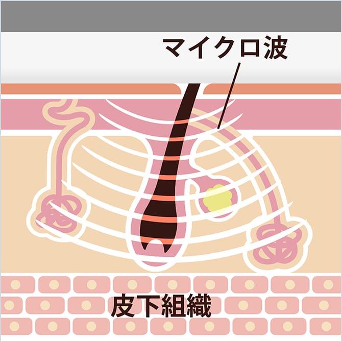 ミラドライによるマイクロ波が汗腺に届く