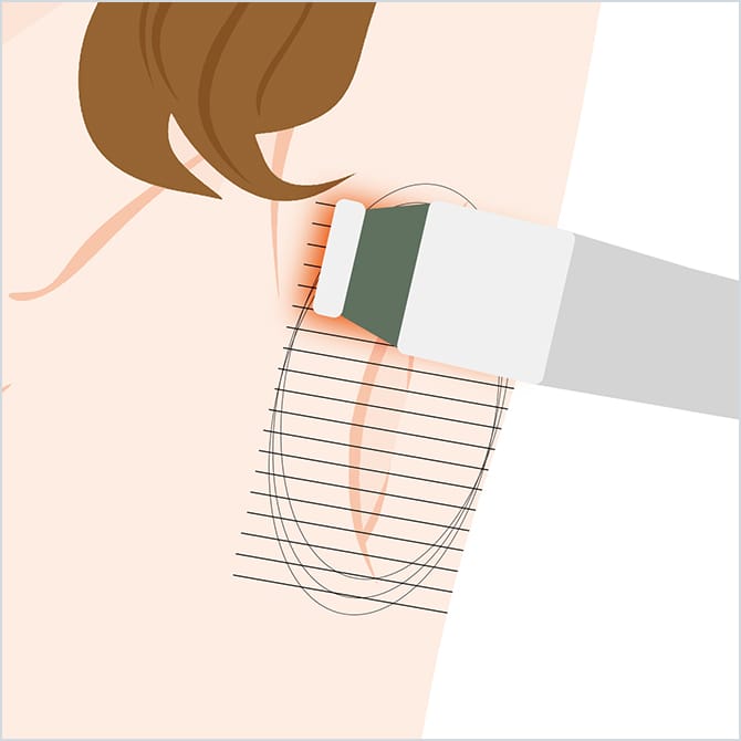 ミラドライによる施術