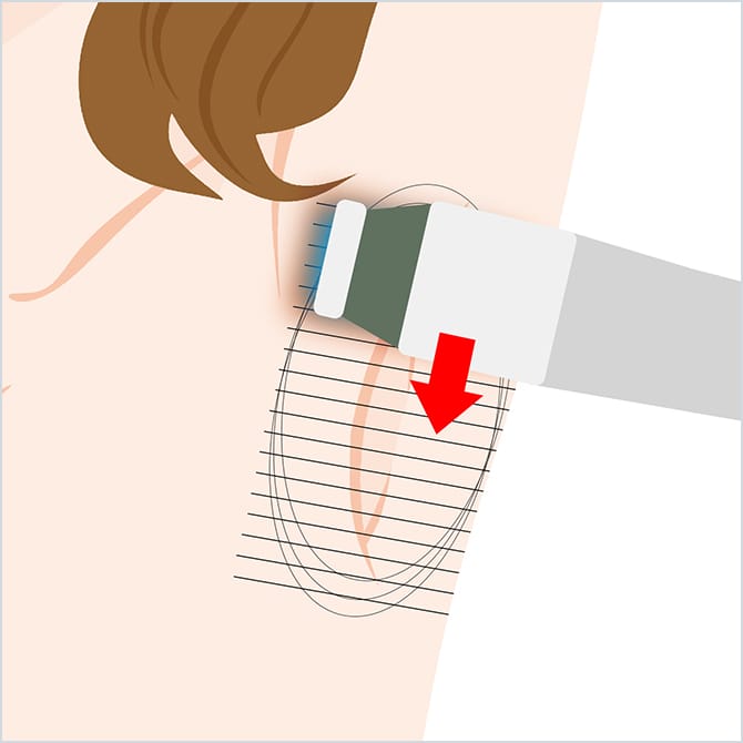 ミラドライによる施術