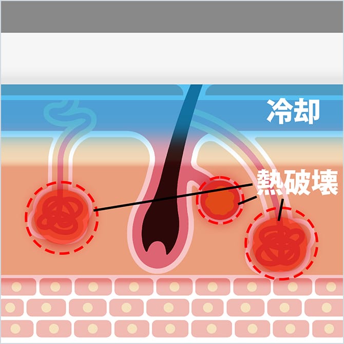 皮膚の表面だけ冷却する