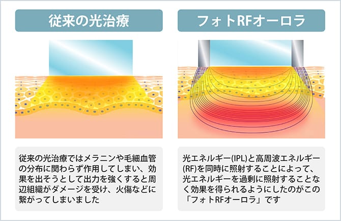 従来の治療とフォトFRの比較画像