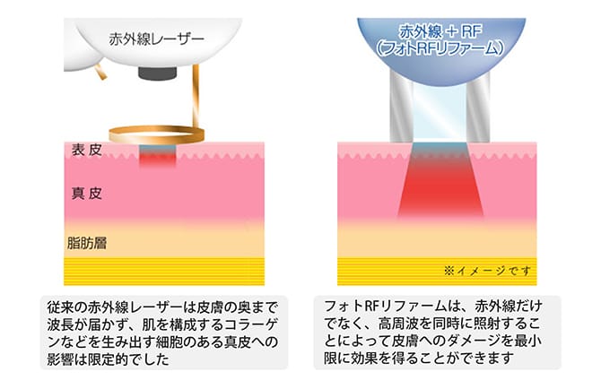 フォトRFリファームイメージ図