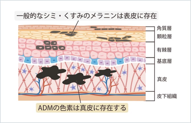 ADM(後天性真皮メラノサイトーシス)の位置