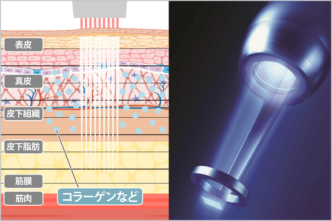 フラクショナルレーザー