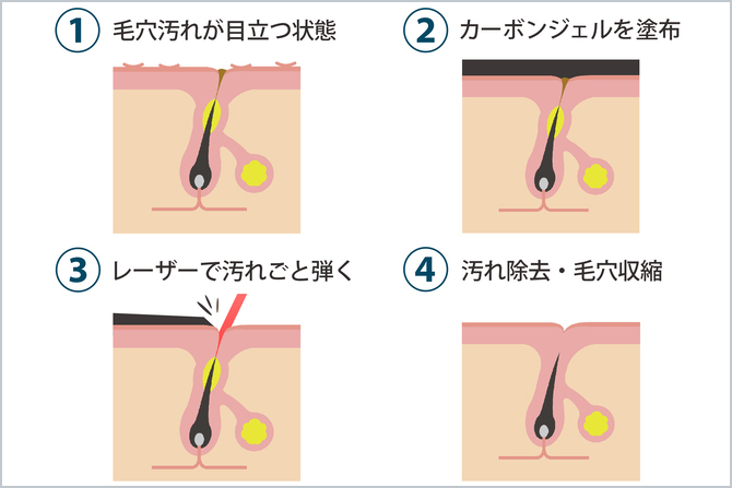ピコレーザーピーリング照射による毛穴の収縮