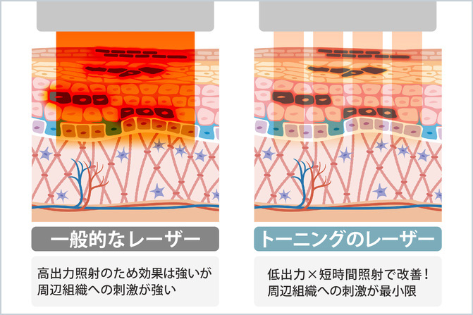 一般的なレーザーとトーニングのレーザーの比較