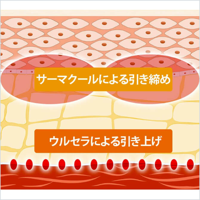 サーマクールによる引き締めとウルセラによる引き上げイメージ図