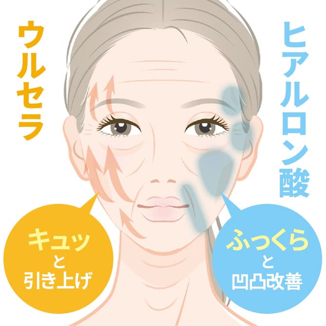 ウルセラリフト+ヒアルロン酸注入