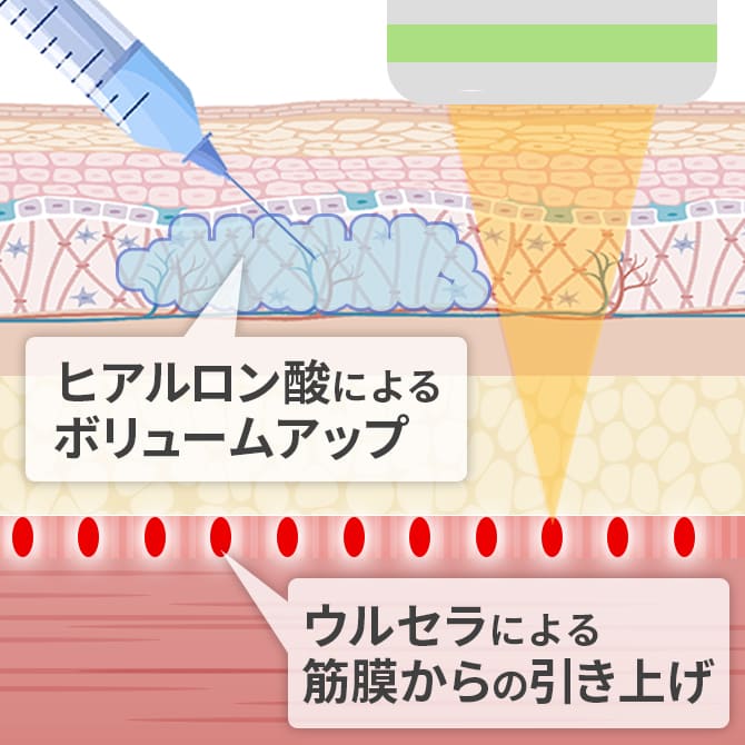 ウルセラとヒアルロン酸注入の2つの相乗効果