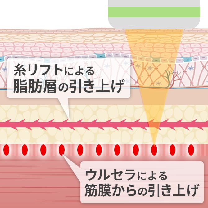 ウルセラと糸リフトの2つの相乗効果