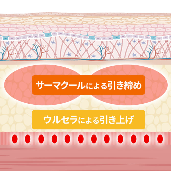 ウルセラとサーマクールの2つの相乗効果