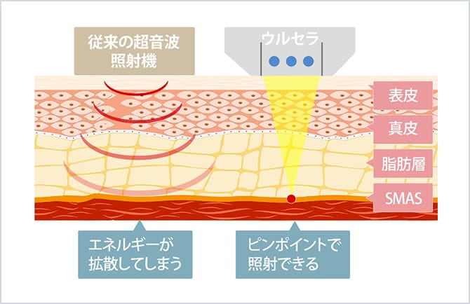 ウルセラと従来の超音波照射機との比較イメージ