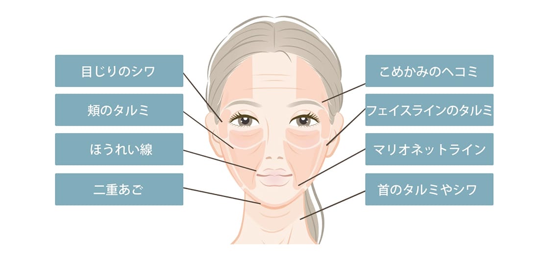 ウルセラリフト(お顔のリフトアップ)| 美容整形外科のジョウ ウルセラリフト(お顔のリフトアップ)| 美容整形外科のジョウ
