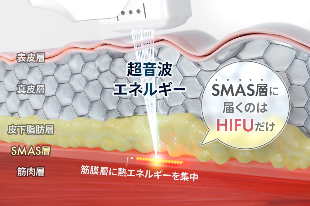 高密度焦点式超音波エネルギー