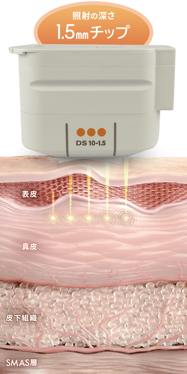 トランスデューサー照射の深さ1.5mmチップ