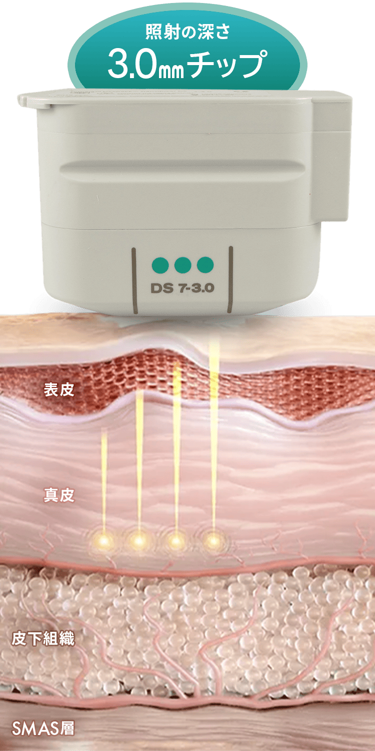 トランスデューサー照射の深さ3.0mmチップ