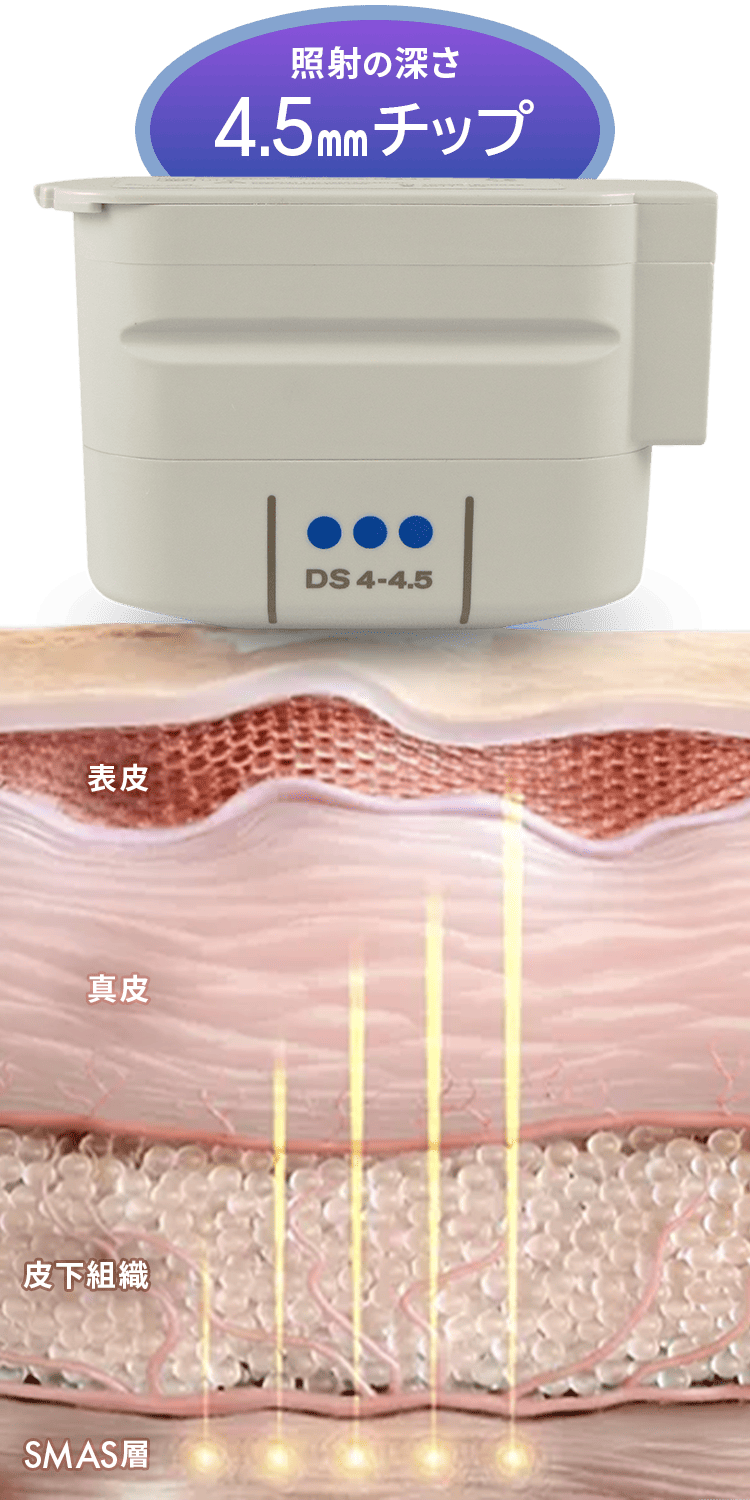 トランスデューサー照射の深さ4.5mmチップ