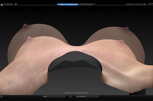 BREAST Sculptor®