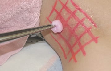 局所麻酔・消毒・ジェル塗布