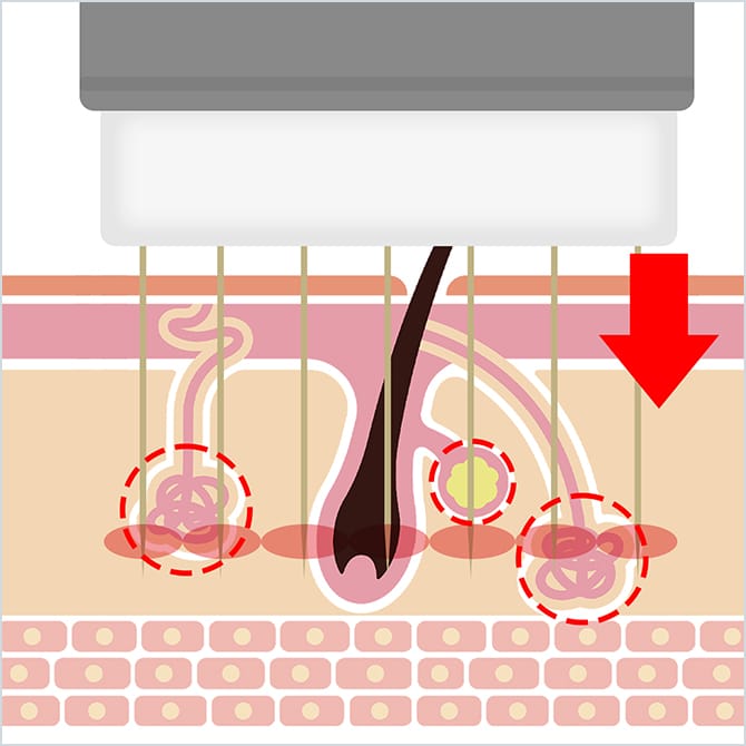 ビューホットでの施術