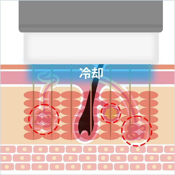 ビューホットでの施術