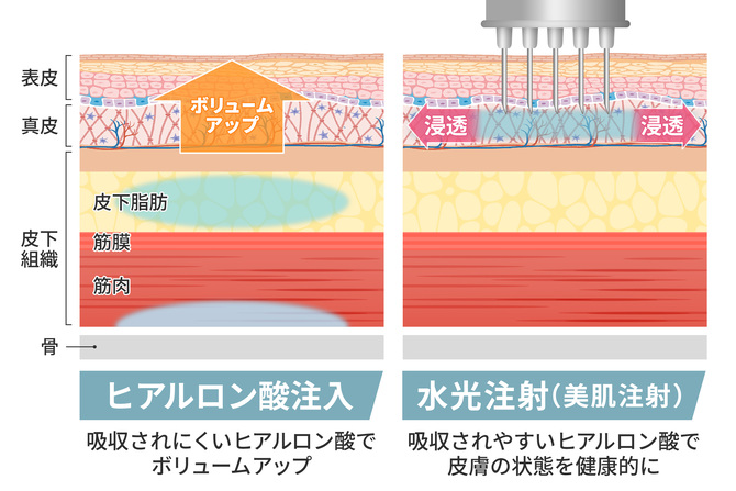 水光注射（HYCOOX・Vital Injector） | 美容整形外科のジョウ