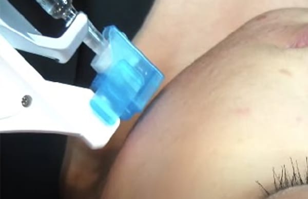 水光注射機による注入