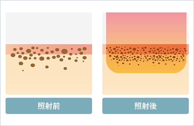レーザー照射前後のメラニン色素のイメージ