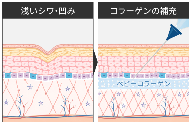 浅いシワや凹みとコラーゲン補充の比較