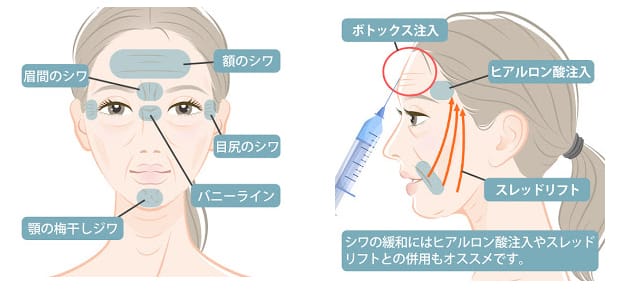 顔から首にかけての注入位置