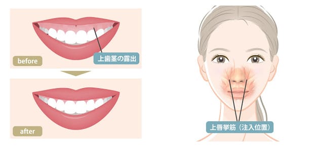 ガミースマイルとボツリヌストキシン治療