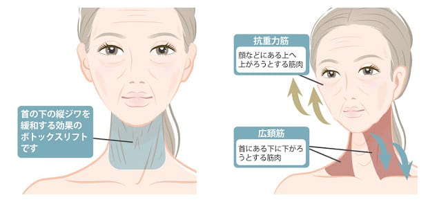 首の縦ジワとボツリヌストキシン治療
