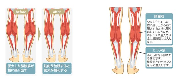 ふくらはぎへのボツリヌストキシン注射