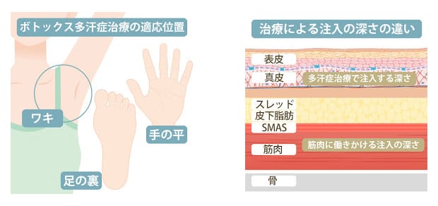ボツリヌストキシン多汗症治療の適応位置