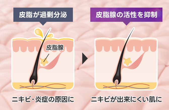 皮脂を抑制しニキビを改善