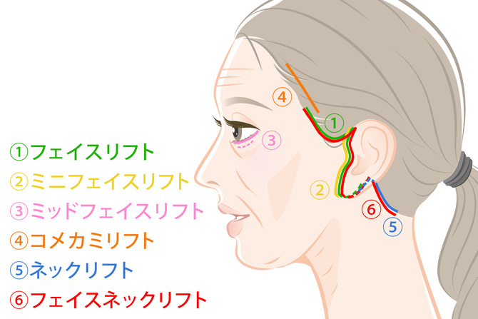 フェイスリフトでの切開位置
