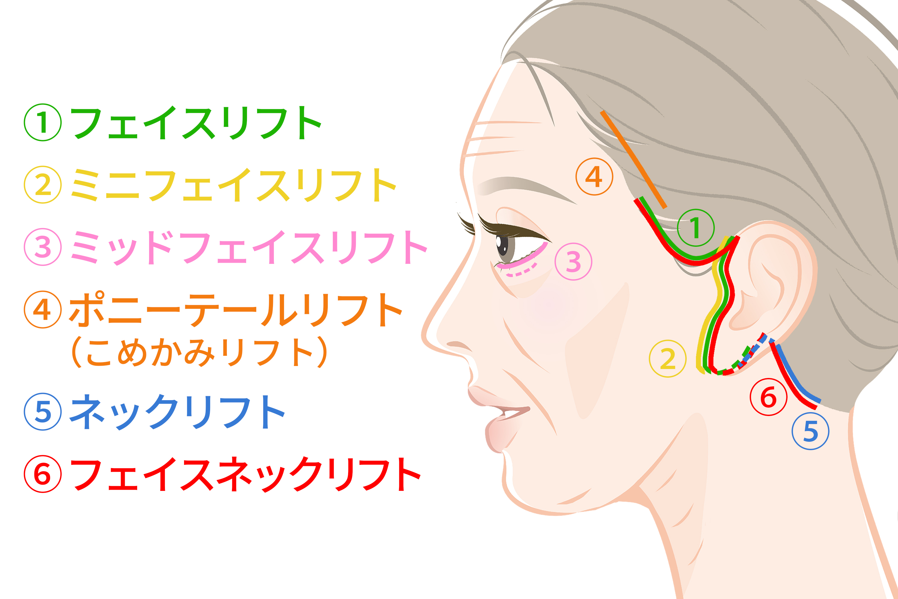 フェイスリフトでの切開位置