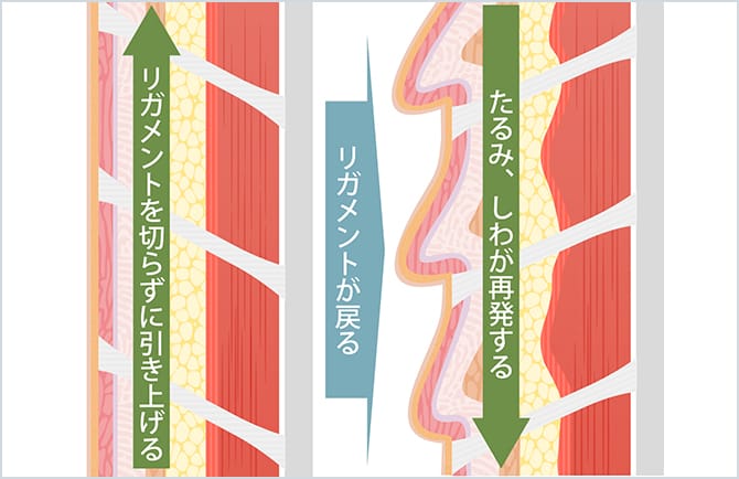 リガメントを切らずに引き上げ、たるみ、シワが再発する様子