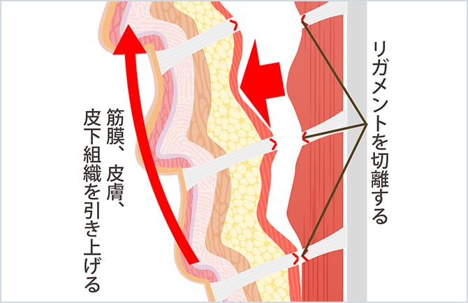 リガメントを切離