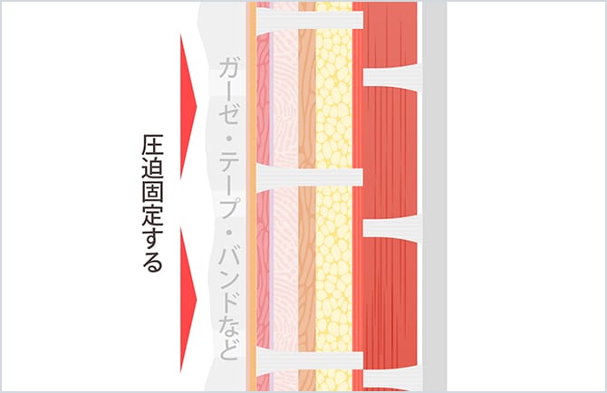 切離したリガメントを固定