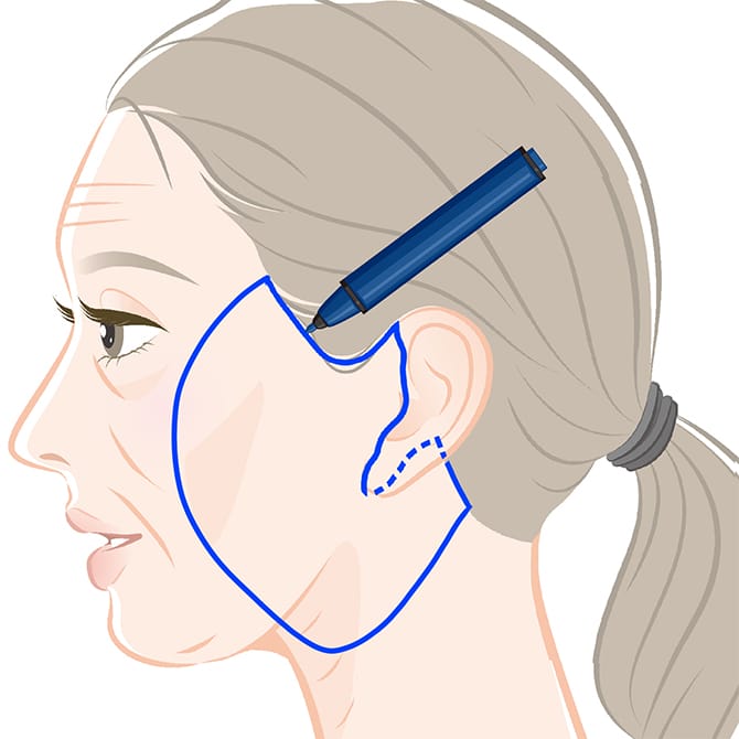 顔にマーキングする図