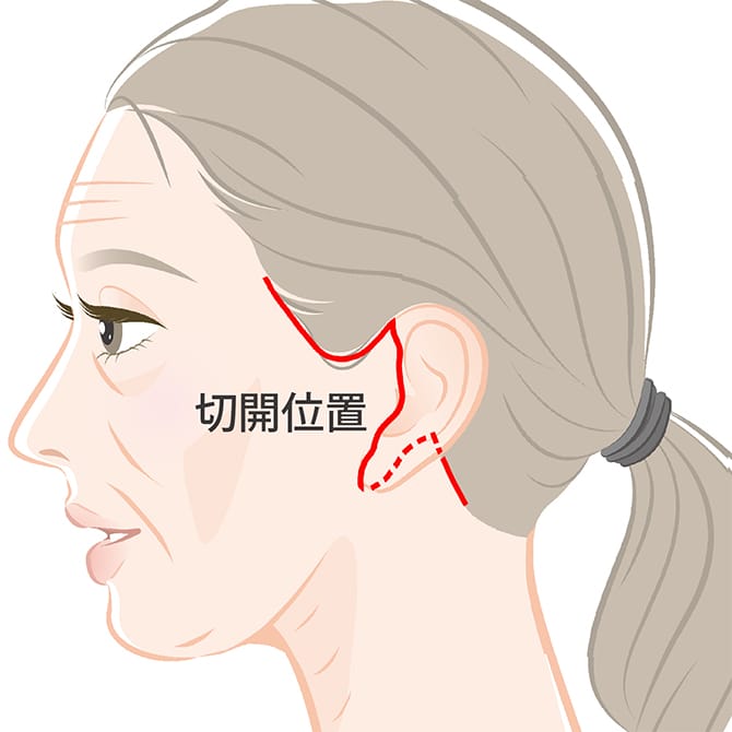 フェイスネックリフトの施術