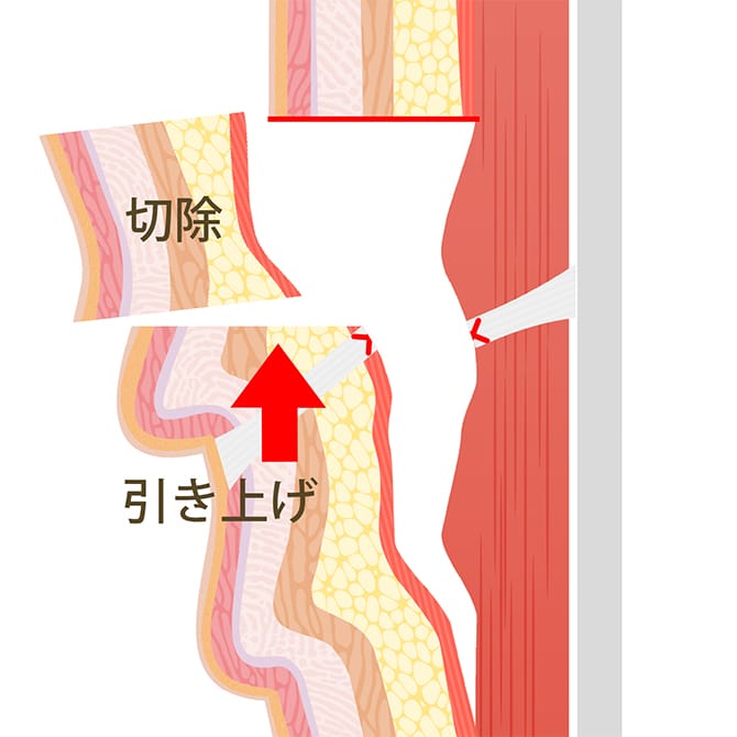 SMASごと皮膚、脂肪層を引き上げ、余った部分を切除する