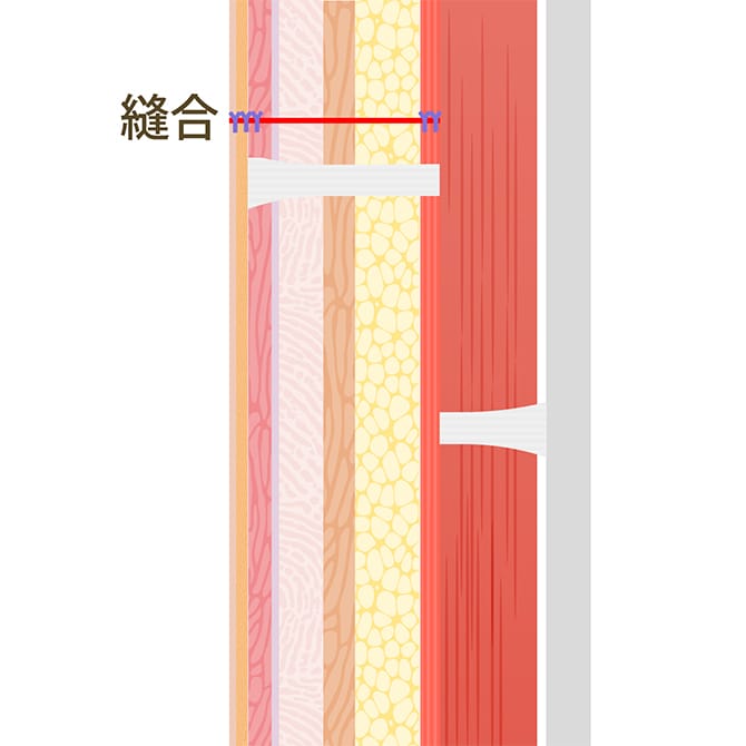SMAS、脂肪層・皮膚を縫合