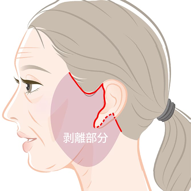フェイスネックリフトの施術
