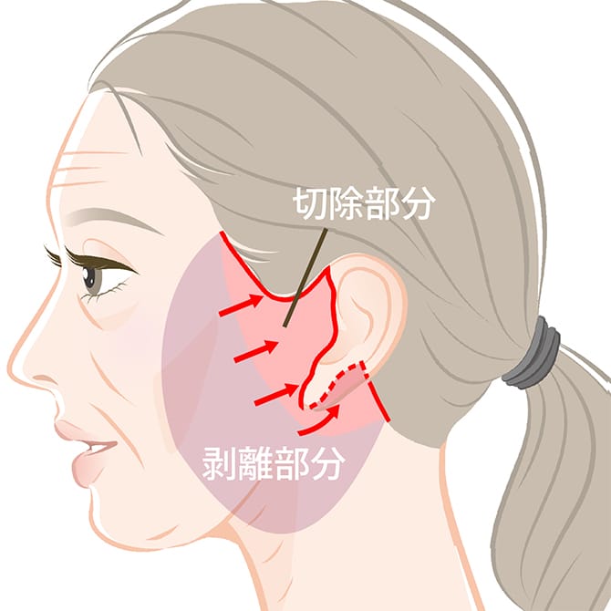 フェイスネックリフトの施術