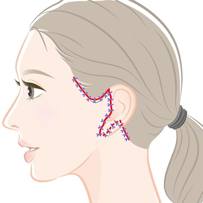 フェイスネックリフトの施術